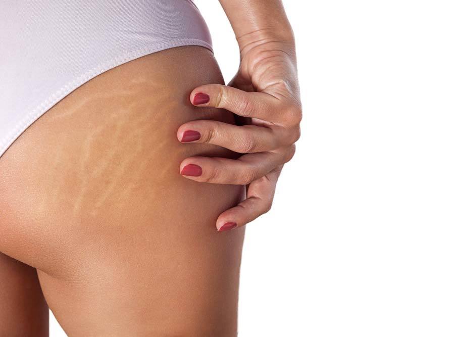 red light therapy stretch marks